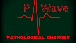 ECG EKG Tips and Tricks  P wave abnormalities  clinical interpretation  all possible Questions [upl. by Ab]