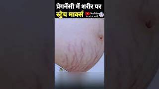 प्रेगनेंसी में स्ट्रेच मार्क्स को कैसे रोकें pregnancystretchmarks striae stretchmark [upl. by Gavini]