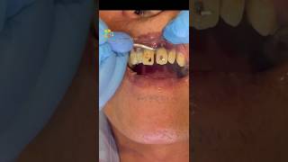 Heavy Tartar Removal  Part 1 dental dentist satisfying [upl. by Uwton]