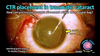 CataractCoach™ 2082 CTR placement in a traumatic cataract [upl. by Harald]