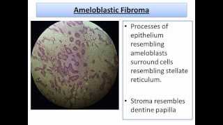 Microscopic Pictures of Variant Oral LesionsOral Pathologywmv [upl. by Hills]