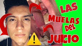 Mi EXPERIENCIA con LAS MUELAS del JUICIO infectado  Levi Zenteno [upl. by Lhary]