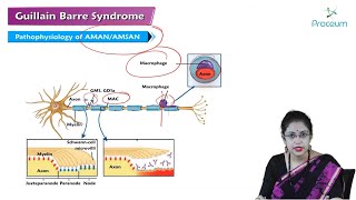 Guillain Barre Syndrome Hindi  Internal Medicine [upl. by Emelen370]