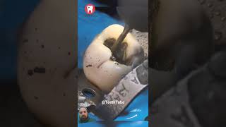 Amalgam Filling Removal dentist dentalfilling satisfying smiledentist oddlysatisfying [upl. by Dalli]