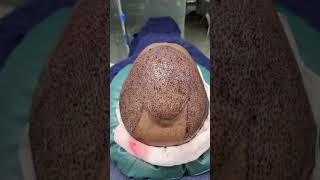 Hair Regrowth Treatment  টাক মাথায় চুল প্রতিস্থাপন চিকিৎসা [upl. by March568]