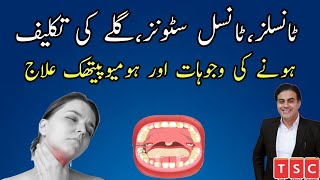 Tonsil ka ilaj  tonsil homeopathic treatment  tonsillitis homeopathic medicine  tonsillitis [upl. by Seni]