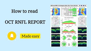 OCT DISC INTERPRETATION  OCT IN GLAUCOMA  OPTOMETRY TAMIL [upl. by Maisel502]