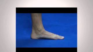 Truth about Flat Feet [upl. by Manoop]