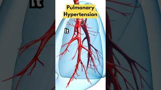 What Is Pulmonary Hypertension [upl. by Uaeb]