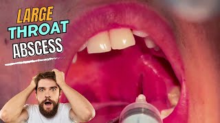 Large Throat Abscess  HUGE RELIEF after Draining a QUINSY aka PERITONSILLAR ABSCESS  Tonsillitis [upl. by Medwin]