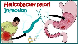 Helicobacter Pylori Infection Gastric Ulcer Causes Signs and Symptoms [upl. by Ansev]