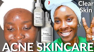 SKINCARE ROUTINE FOR ACNE AND HYPERPIGMENTATION AFFORDABLE SKINCARE KOREAN SKINCARE CLEAR SKIN [upl. by Anemij]