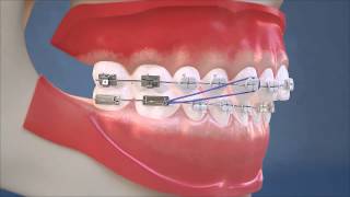 Class II Elastics  Lateral View HD Edition [upl. by Kingsley85]