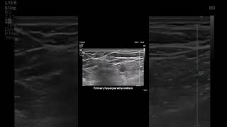 Parathyroid Lesion in the Thymic Remnant radiology ultrasound endocrinegland tumour [upl. by Cock]