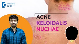 Pimples on NeckBack of head  Acne Keloidalis Nuchae Treatment  DrRajdeep Mysore Doctors Circle [upl. by Tine]