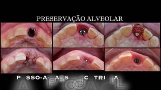 Preservação Alveolar Anterior com Coroa de Emax cimentada sobre Pilar de Zircônia e sobre implante [upl. by Yregram]