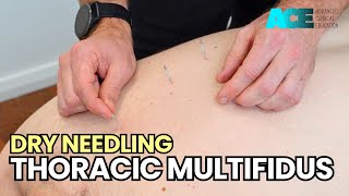 Dry Needling Thoracic Multifidus [upl. by Einre]