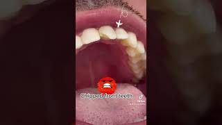 Chipped front teeth  emergency patient [upl. by Ahteral]