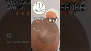 Unbelievable SMp hair loss transformation 🙌🏼 By Claudia smp scalpmicropigmentation [upl. by Oninrutas]