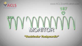 Ventricular Tachycardia by ACLS Certification Institute [upl. by Niatsirt]