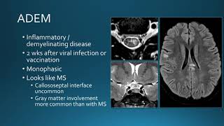 Intradural spinal inflammatory lesions [upl. by Eelarual]