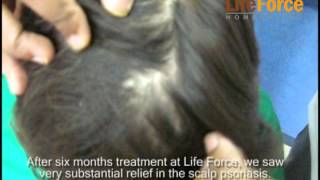 Follow up of Scalp psoriasis cured with homeopathy before and after FU video L  14889 M2mpg [upl. by Downes]