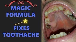 Relieve severe toothache with this magical formula GUARANTEED [upl. by Cherry]