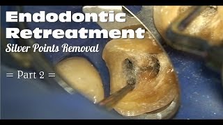 Endodontic Retreatment  Silver Points Removal Part 2 [upl. by Maryanna906]