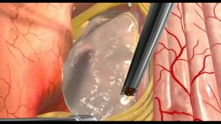 Animation  Spinal Cord Intramedullary Tumormov [upl. by Niu]