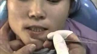 How to scrape the chin for demodex mites [upl. by Karas168]