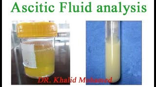 Ascitic fluid analysis تحليل السائل البريتوني [upl. by Enyaht]