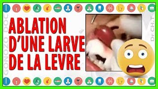 ablation  extraction  dune larve de la lèvre [upl. by Sueddaht]