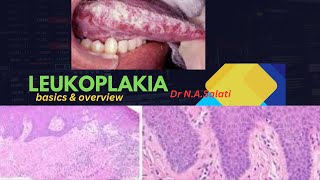 Leukoplakia Differential Diagnosis [upl. by Notneuq319]