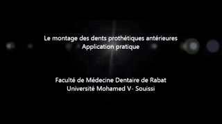 Montage des dents prothétiques antérieures [upl. by Reace]