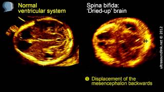 Spina bifida 3D ultrasound diagnosis at 1113 weeks [upl. by Agathe752]