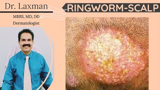 Tinea Capitis  Fungal Infection Of Scalp  Scalp Ringworm  Hair Fungus  Kerion  Black Dot [upl. by Battiste6]