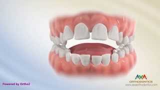 Orthodontic Treatment for Tongue Thrusting Habit  Different Options [upl. by Elum317]