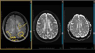 Demyelination Case Review  ADC Negative Multiple Sclerosis [upl. by Besse]