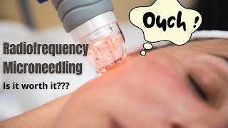 Radiofrequency Microneedling  Does it actually work  Dermatologist reviews [upl. by Lerraj]