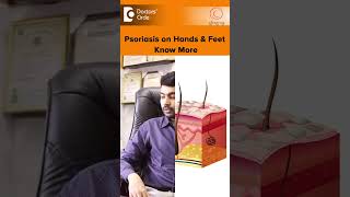 PSORIASIS on Hands amp Feet Palmoplantar Psoriasis TreatmentDrRajdeep MysoreDoctors Circleshorts [upl. by Dotty]