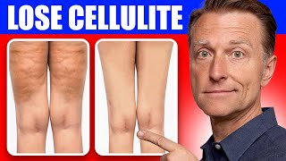 Get Rid of Cellulite for Good Dr Bergs Better Way to Lose Flabby Fat [upl. by Pavyer]