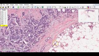 Breast ductal carcinoma Breast cancer [upl. by Chaves228]