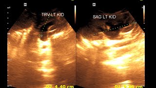 Bilateral hydro nephrosis  Bilateral dilated ureter  Renal Ultrasonography [upl. by Cohe]