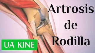 ¿Qué Significa el Líquido en tu Rodilla Descubre las Posibles Lesiones [upl. by Prudhoe]