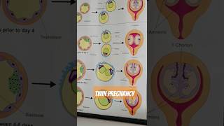 dizygotic and monozygotic definition for TWINS Pregnancy 😳😍 [upl. by Annanhoj]