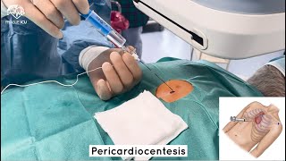 Pericardiocentesis [upl. by Siuqramed850]