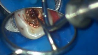 furcation perforation closure  закрытие фуркационной перфорации [upl. by Noroj]