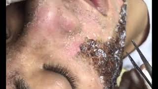 Chemical Peel Result After Treatment  Face Peel for Acne Part 1 22 August 2019 [upl. by Sirmons]