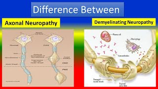 Different between Axonal Neuropathy and Demyelinating Neuropathy [upl. by Alleira]