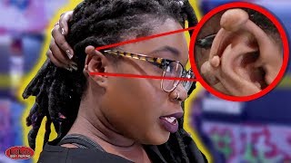 IF YOU HAVE A KELOID YOU NEED TO WATCH THIS [upl. by Al]